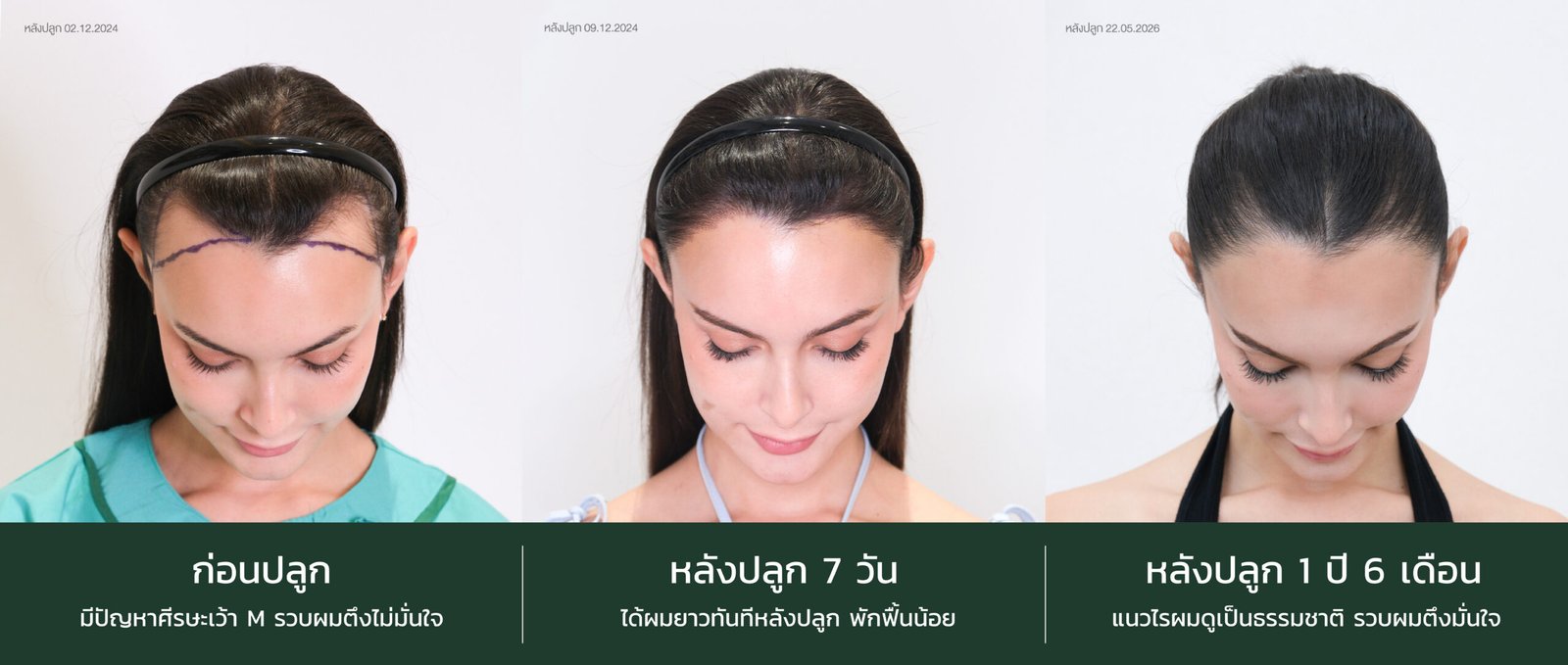 คุณโอเว่น Long hair Before 1 week 1Y6M ก้มหน้า 1