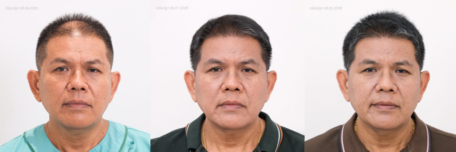 Age and Hairloss 3