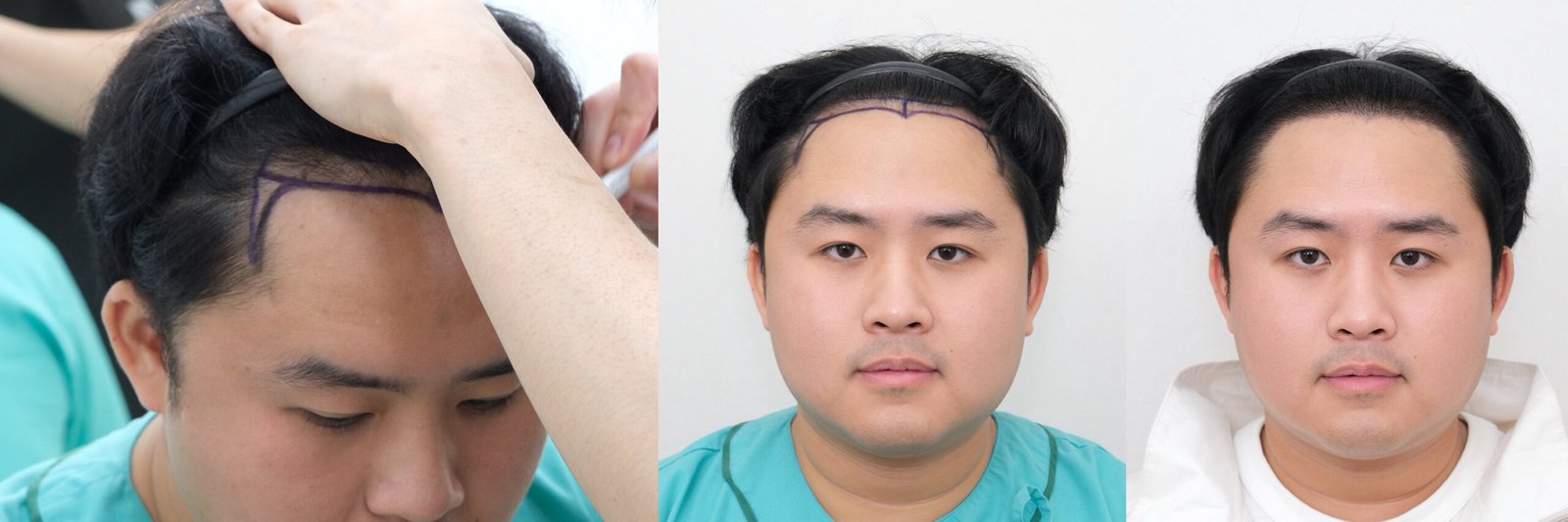 ปลูกกี่กราฟต์ 4